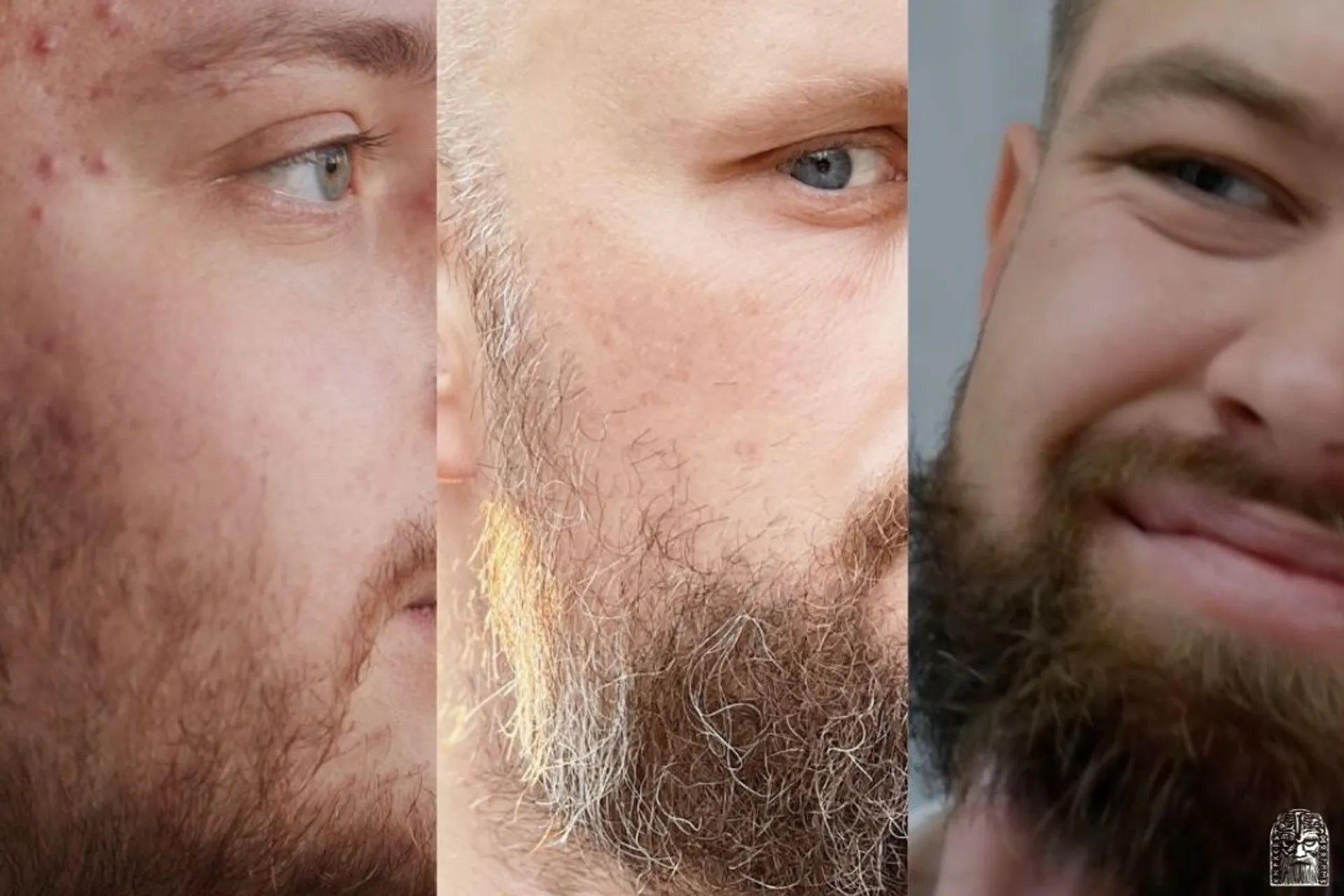 Common beard problems