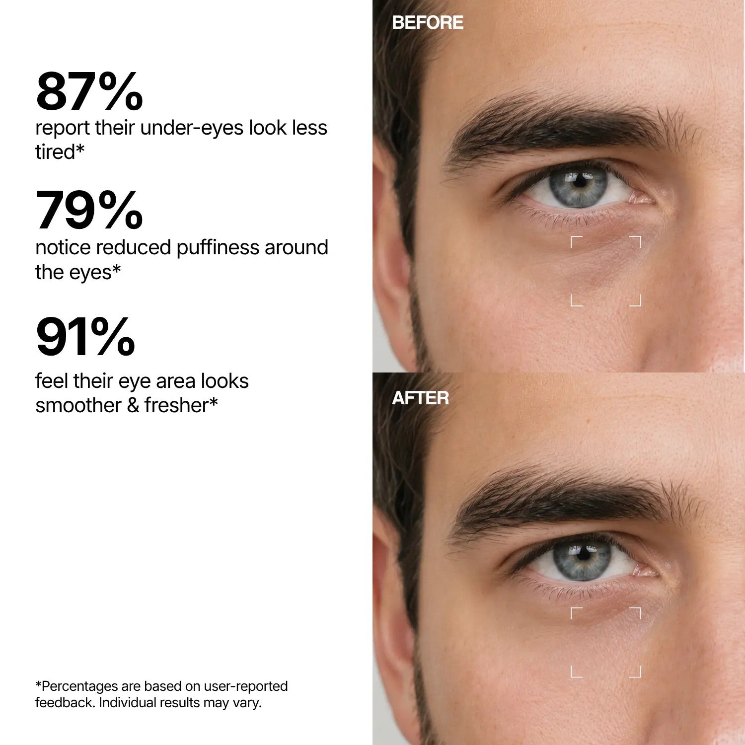 Eye Rescue Before and After — Men's dark circles and puffiness results