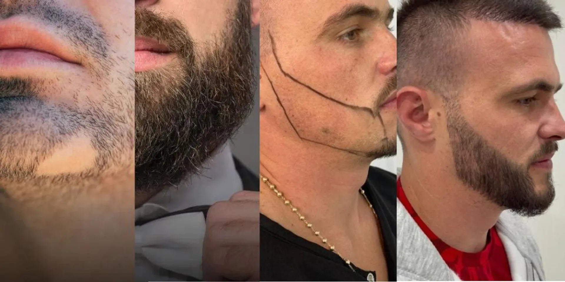 Beard transplant