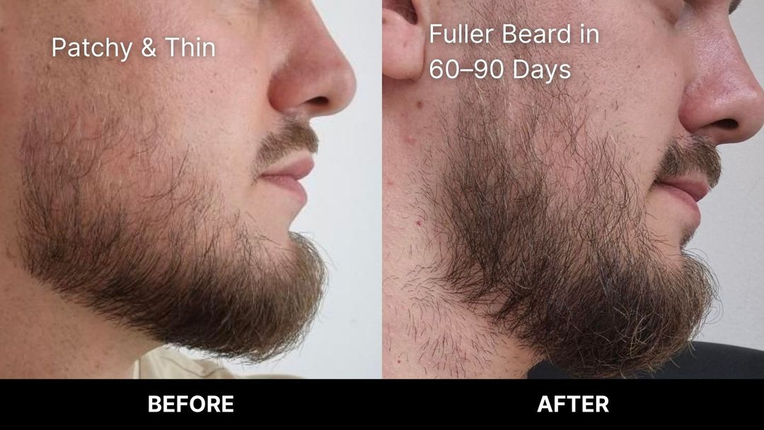 Before and after beard roller beard growth