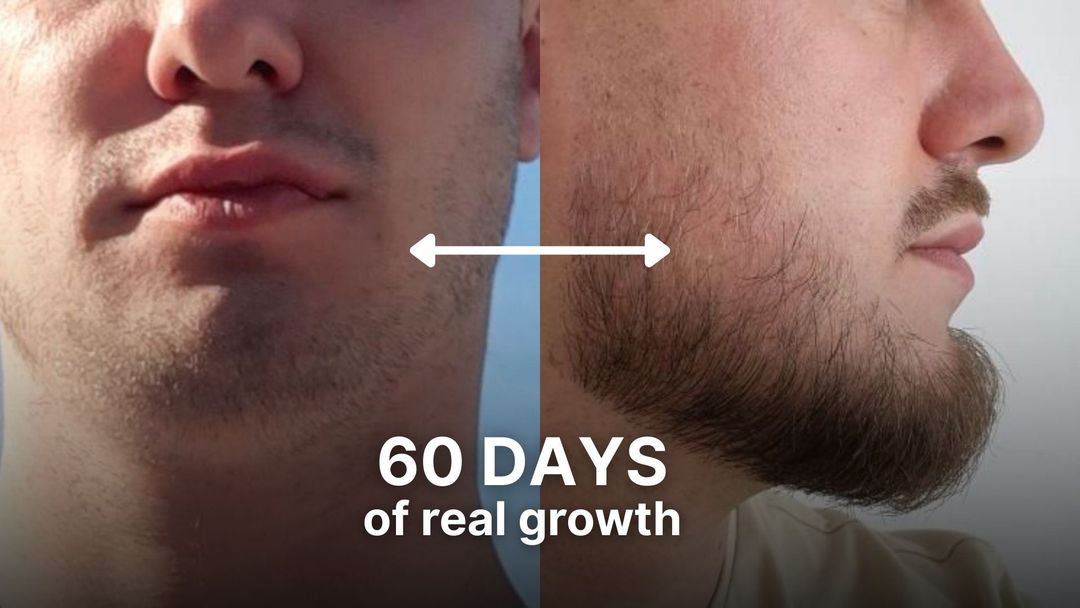 Before and after results from Odenson Beard Serum