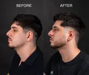 Before-after beard growth